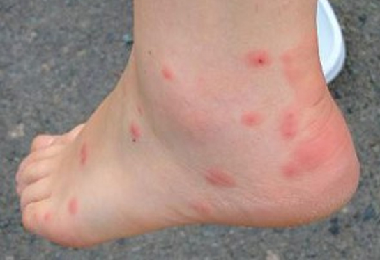 bites