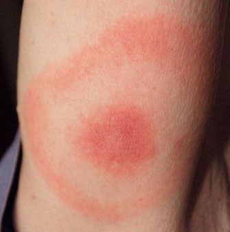lyme rash